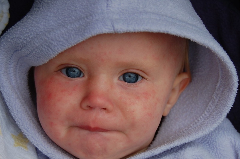 Northern VA measles case confirmed: Health authorities trying to notify people at risk