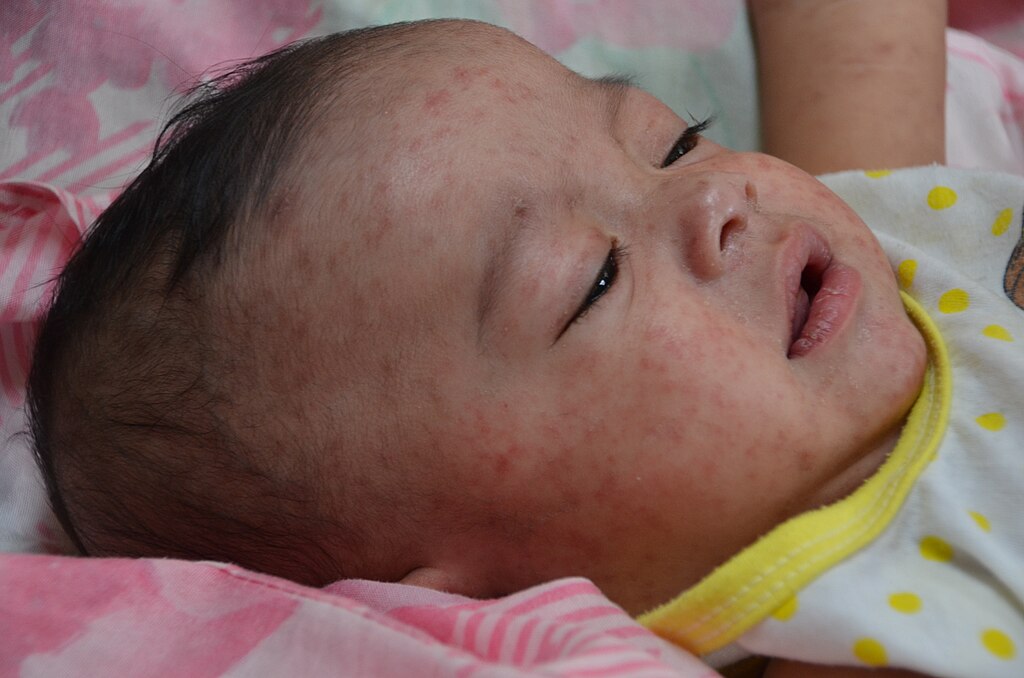 Northern VA measles investigation underway on heels of 3rd confirmed case
